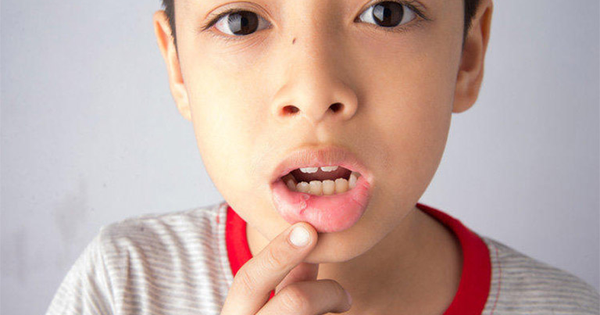 Cách giúp trẻ em vượt qua cảm giác khó chịu khi bị lở miệng.
