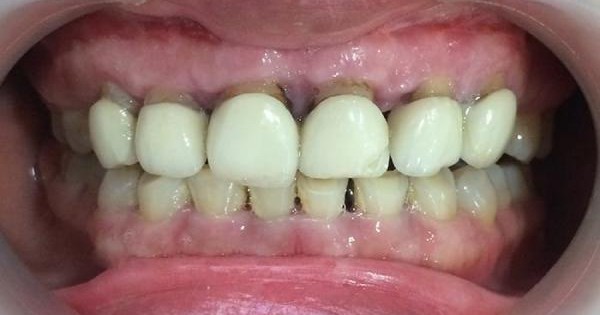  Hậu quả bọc răng sứ : Những điều cần lưu ý khi lựa chọn