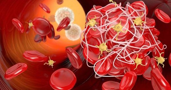 Nguyên nhân và cách điều trị khi máu đông trong não xảy ra