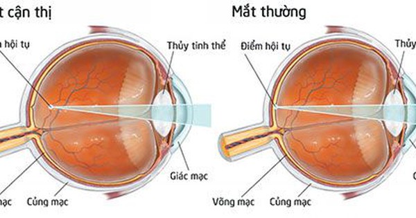 Tại sao dung dịch nhỏ mắt chứa Atropine 0.01% được coi là phương pháp kiểm soát cận thị hiệu quả nhất cho trẻ em?
