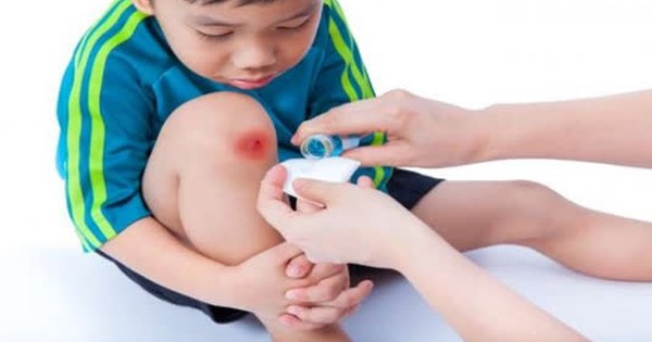 Bác sĩ hướng dẫn cách sơ cứu khi trẻ bị ngã và có chấn thương