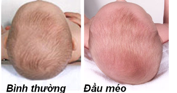 Đầu bé yêu của bạn bị méo? Chẳng cần phải lo lắng nữa, chúng tôi sẽ giúp bé của bạn có được đầu hợp sức khỏe. Hãy đến và xem những hình ảnh minh họa.