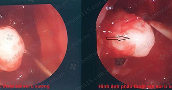 Hiểu rõ hơn về u xương xoang trán các triệu chứng và phương pháp chữa trị