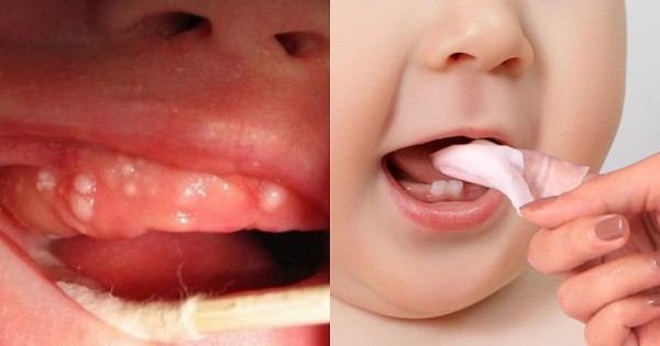 Cách chăm sóc các răng nanh của trẻ sơ sinh?
