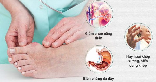 Gout Kingphar có tác dụng làm giảm viêm khớp do Gout như thế nào?
