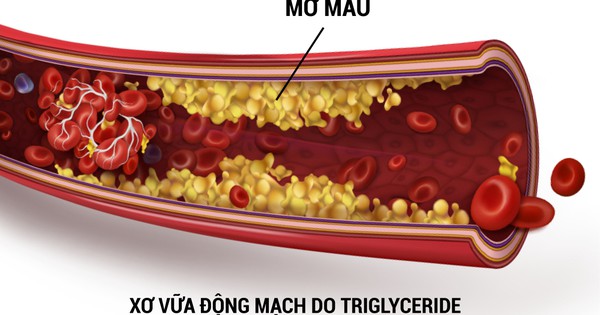 Thói quen vận động thể dục thường xuyên có ảnh hưởng đến mỡ máu triglyceride như thế nào?
