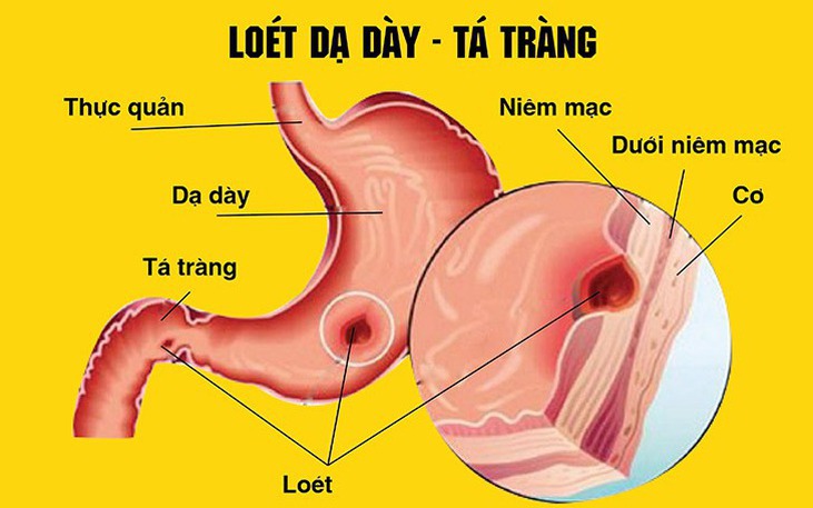 Lo&#233;t dạ d&#224;y t&#225; tr&#224;ng: Nguy&#234;n nh&#226;n, triệu chứng, ph&#242;ng ngừa v&#224; c&#225;ch điều trị