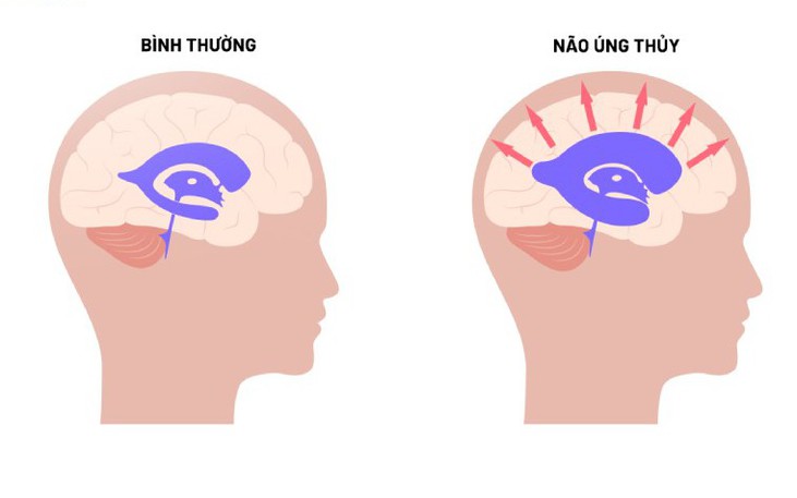 N&#227;o &#250;ng thủy: Nguy&#234;n nh&#226;n, triệu chứng, ph&#242;ng ngừa v&#224; c&#225;ch điều trị