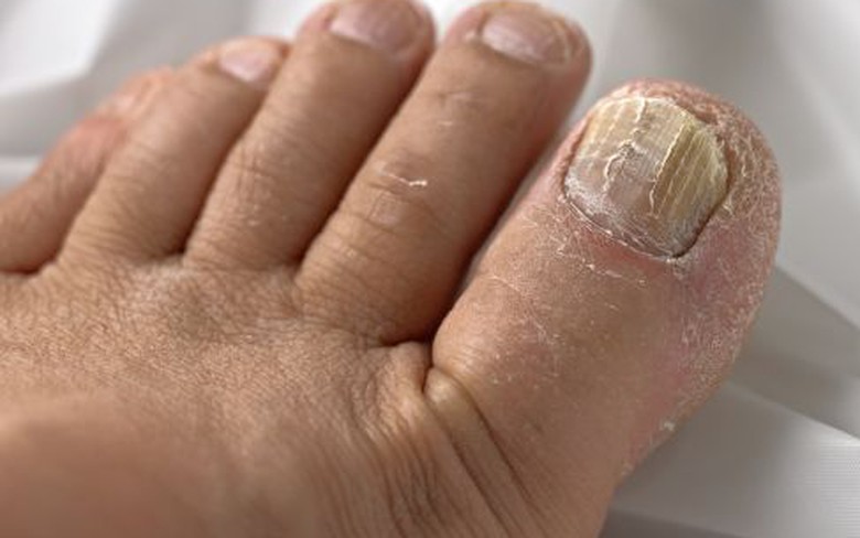 Móng chân bị dày sần sùi, bệnh gì?